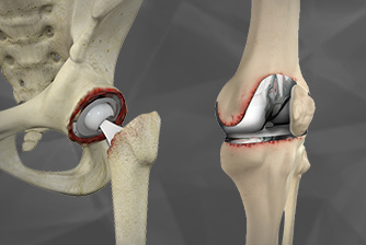 Minimally invasive hip replacement surgery